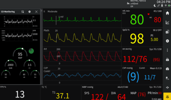 Première mondiale à Château-Thierry : le bloc opératoire du CH Jeanne de Navarre entre dans une nouvelle ère de surveillance anesthésique. © Le Centre hospitalier Jeanne de Navarre