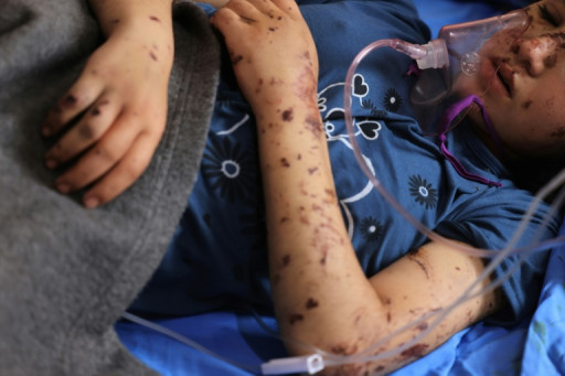 "Rattachez moi mes jambes": l'effroi des enfants amputés dans Gaza en guerre